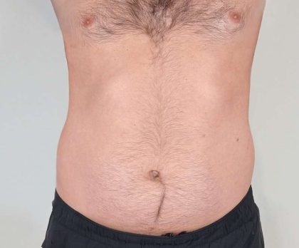 Men's Liposuction Before & After Patient #1379