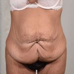 Tummy Tuck Before & After Patient #206