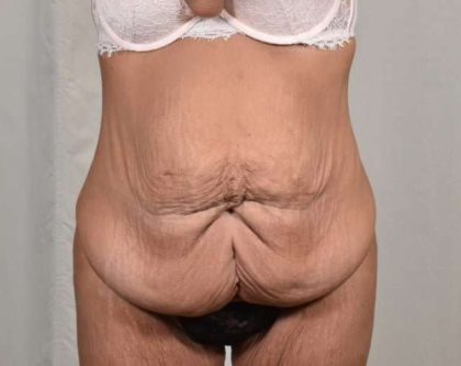 Tummy Tuck Before & After Patient #206
