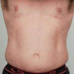 Men's Liposuction Before & After Patient #1384