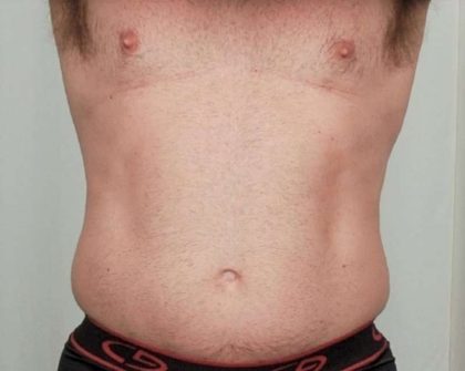 Men's Liposuction Before & After Patient #1384