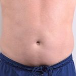 Men's Liposuction Before & After Patient #1389