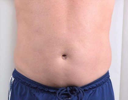 Men's Liposuction Before & After Patient #1389