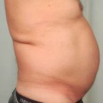 Men's Liposuction Before & After Patient #1396