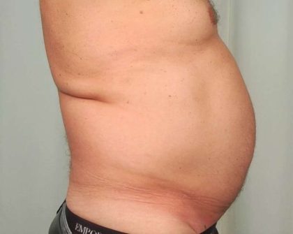 Men's Liposuction Before & After Patient #1396