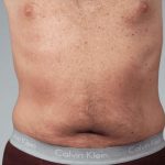 Men's Liposuction Before & After Patient #1401