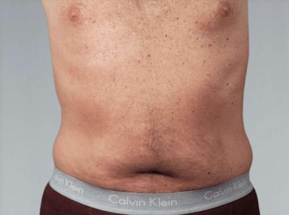 Men's Liposuction Before & After Patient #1401