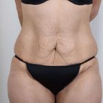 Tummy Tuck Before & After Patient #221