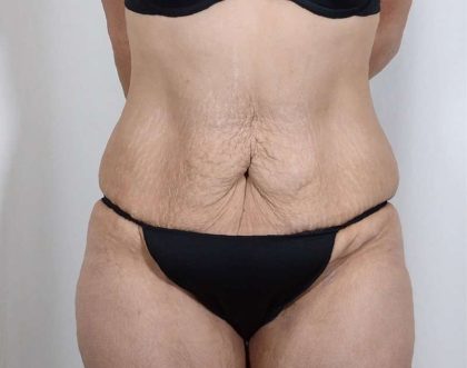 Tummy Tuck Before & After Patient #221