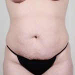 Tummy Tuck Before & After Patient #226