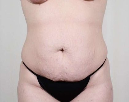 Tummy Tuck Before & After Patient #226