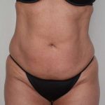 Tummy Tuck Before & After Patient #231