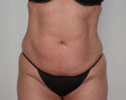 Tummy Tuck Before & After Patient #231