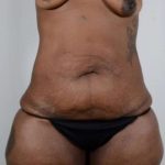 Tummy Tuck Before & After Patient #251