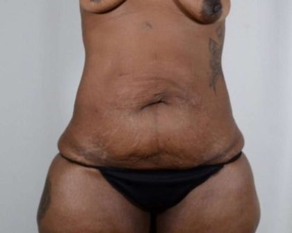 Tummy Tuck Before & After Patient #251