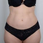 Tummy Tuck Before & After Patient #271