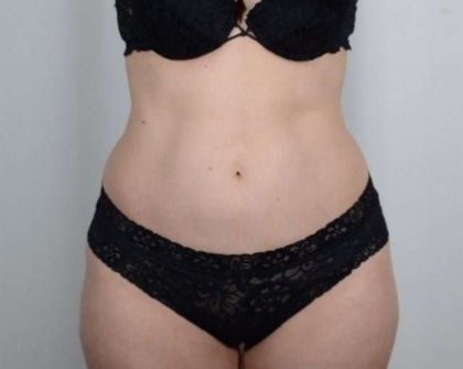 Tummy Tuck Before & After Patient #271