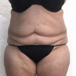 Tummy Tuck Before & After Patient #276