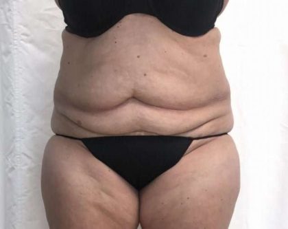 Tummy Tuck Before & After Patient #276