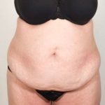 Tummy Tuck Before & After Patient #291