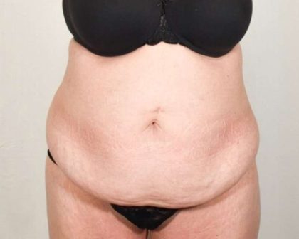 Tummy Tuck Before & After Patient #291