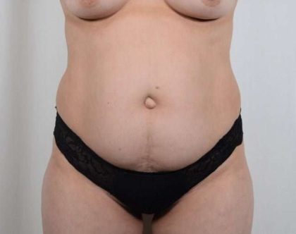 Tummy Tuck Before & After Patient #296