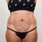 Tummy Tuck Before & After Patient #301