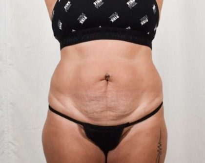 Tummy Tuck Before & After Patient #301