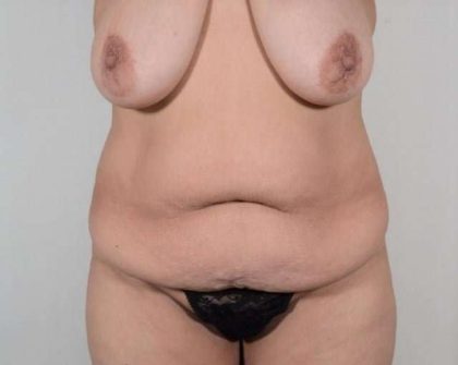 Tummy Tuck Before & After Patient #306