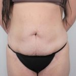 Tummy Tuck Before & After Patient #311