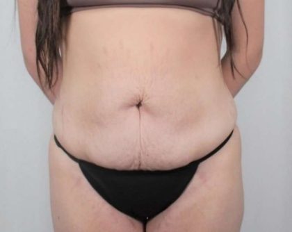 Tummy Tuck Before & After Patient #311