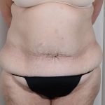 Tummy Tuck Before & After Patient #316