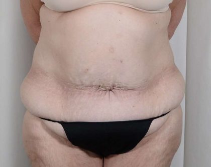 Tummy Tuck Before & After Patient #316