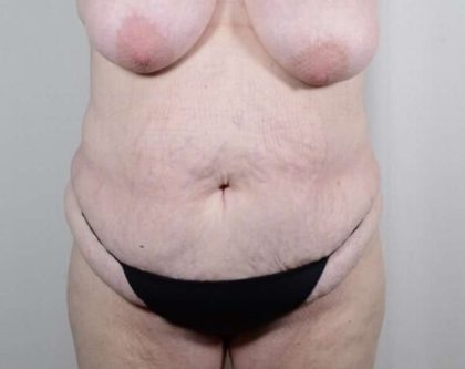 Tummy Tuck Before & After Patient #326