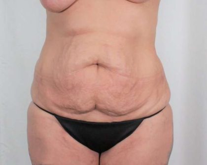 Tummy Tuck Before & After Patient #331