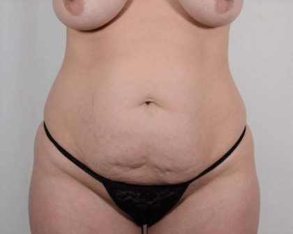 Tummy Tuck Before & After Patient #336