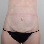 Tummy Tuck Before & After Patient #346