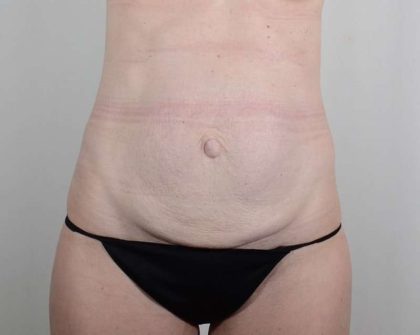 Tummy Tuck Before & After Patient #346