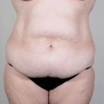 Tummy Tuck Before & After Patient #351