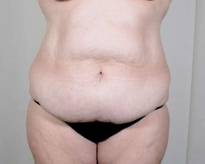 Tummy Tuck Before & After Patient #351