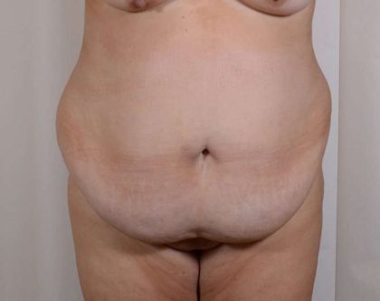 Tummy Tuck Before & After Patient #356