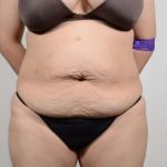 Tummy Tuck Before & After Patient #361