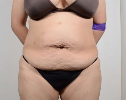 Tummy Tuck Before & After Patient #361