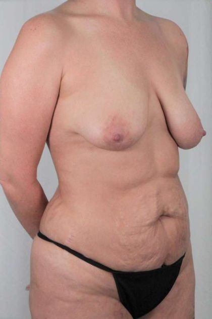 Mommy Makeover Before & After Patient #391