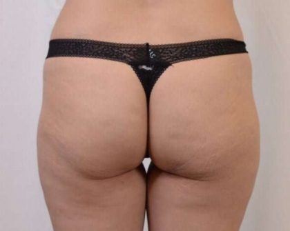 Brazilian Butt Lift Before & After Patient #413