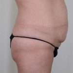Brazilian Butt Lift Before & After Patient #418