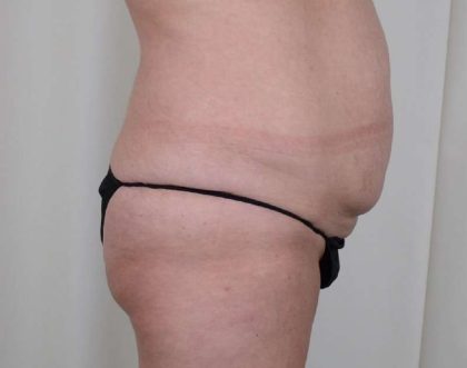 Brazilian Butt Lift Before & After Patient #418