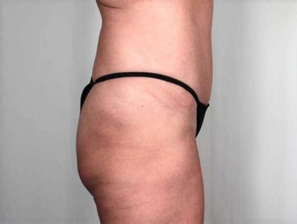 Brazilian Butt Lift Before & After Patient #428