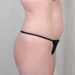 Brazilian Butt Lift Before & After Patient #433