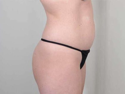 Brazilian Butt Lift Before & After Patient #433